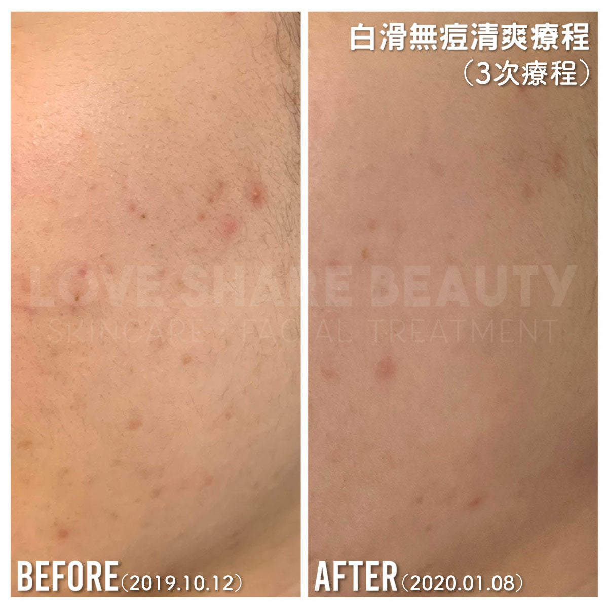 白滑無痘清爽療程(單次)