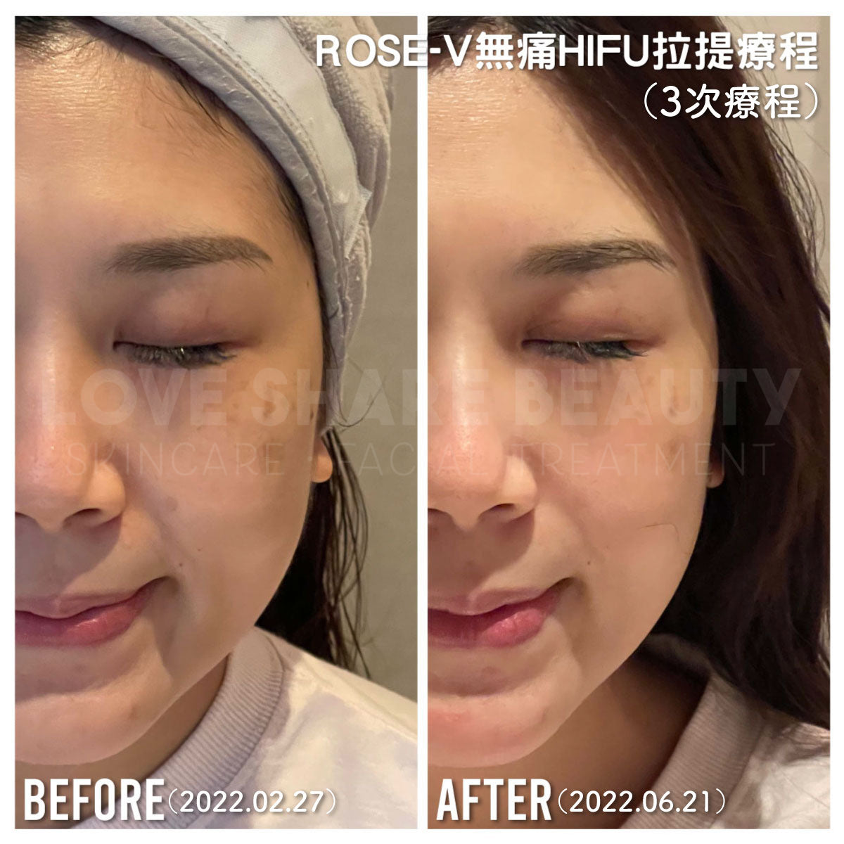 Rose V Line 無針埋線(單次)