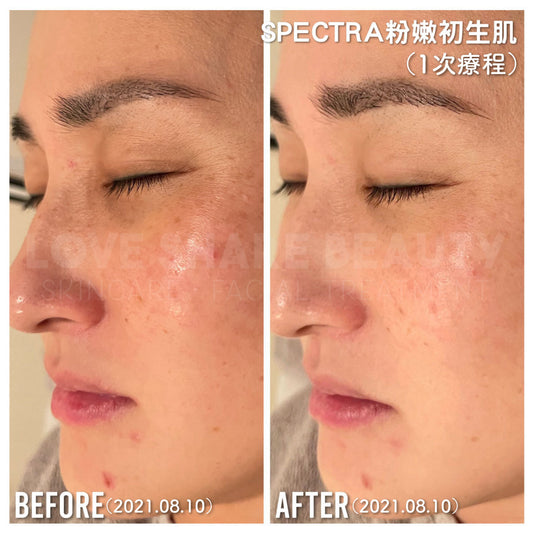Spectra 粉嫩初生肌(單次)