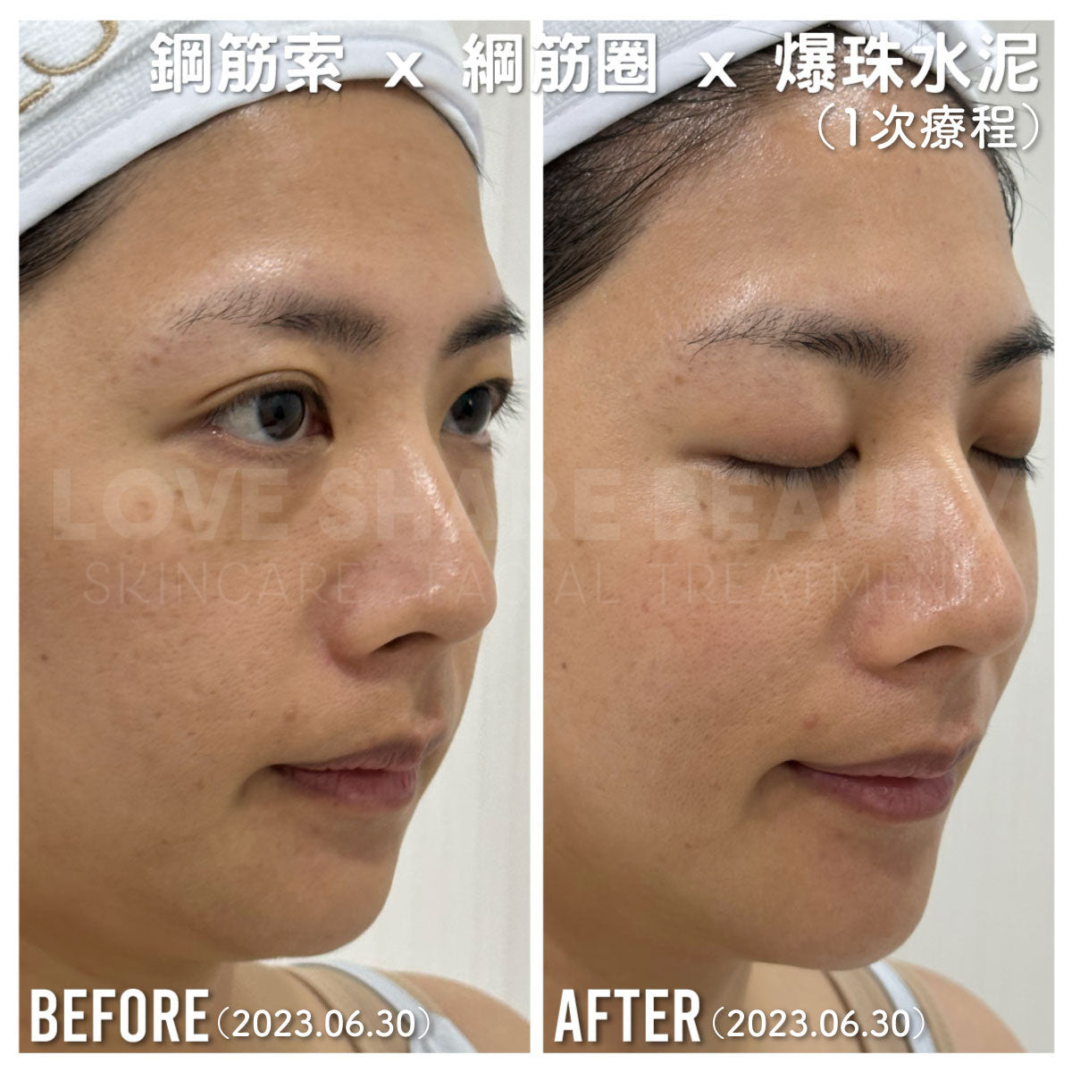 鋼筋索 Ultraformer MPT(單次)