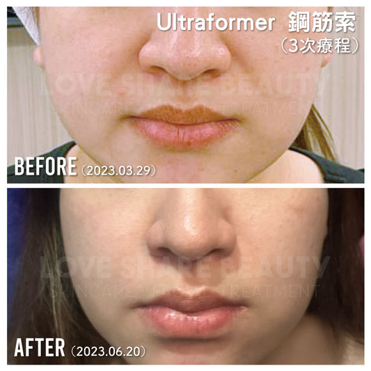 鋼筋索 Ultraformer MPT(單次)