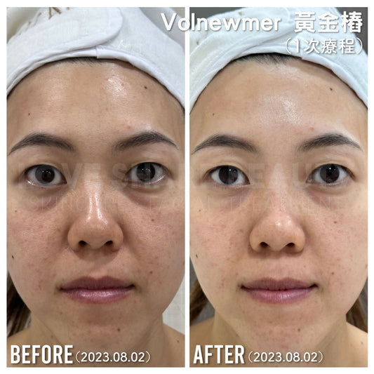 Volnewmer黃金椿(單次)