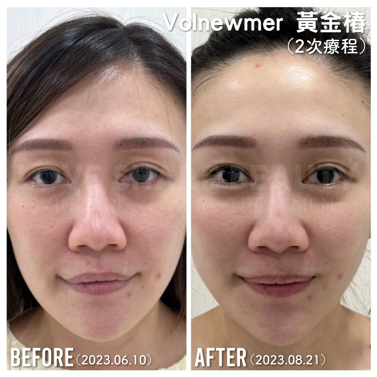 Volnewmer黃金椿(單次)