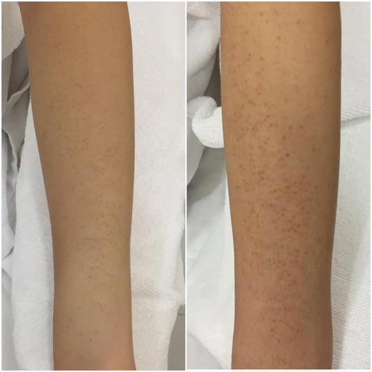 Magic Peel CPS 果酸換膚療程(單次)